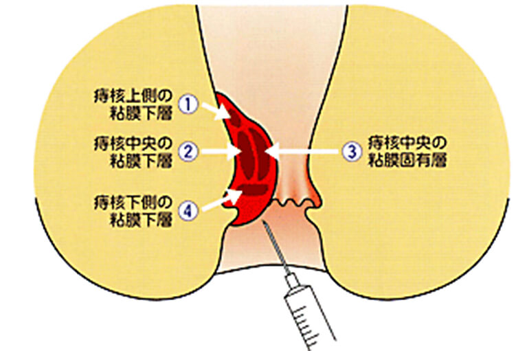 ジオン注射の投与について