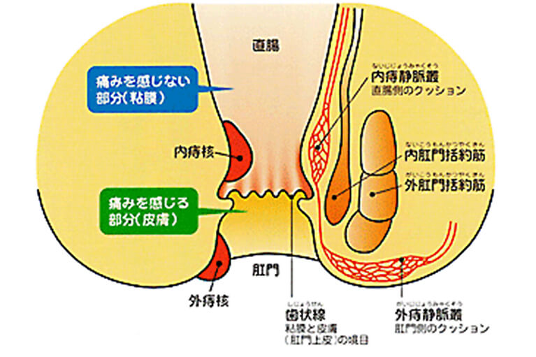 いぼ痔（内痔核）とは